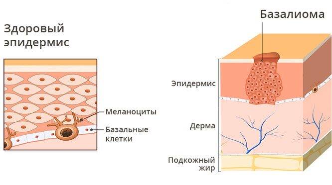 Новообразования на коже лица, руки, шеи, ягодиц, стопы ноги, головы. Виды, причины, удаление лазером