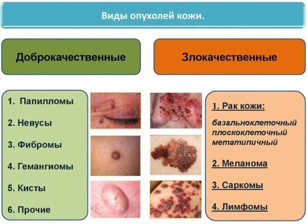 Новообразования на коже лица, руки, шеи, ягодиц, стопы ноги, головы. Виды, причины, удаление лазером