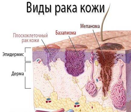 Новообразования на коже лица, руки, шеи, ягодиц, стопы ноги, головы. Виды, причины, удаление лазером