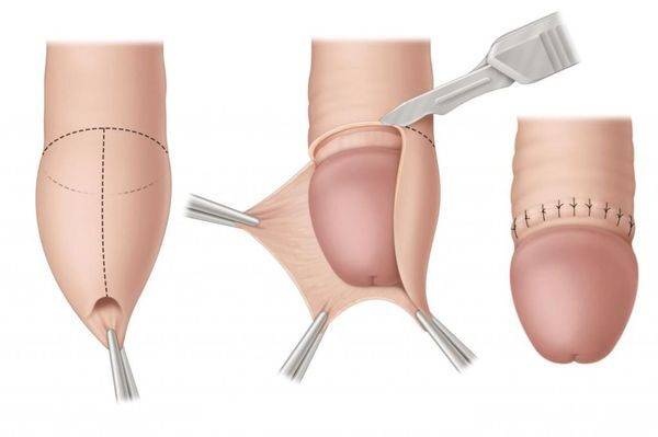 Обрезание крайней плоти