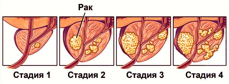 Стадии рака простаты