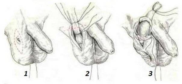 Последовательность операции орхиэктомии