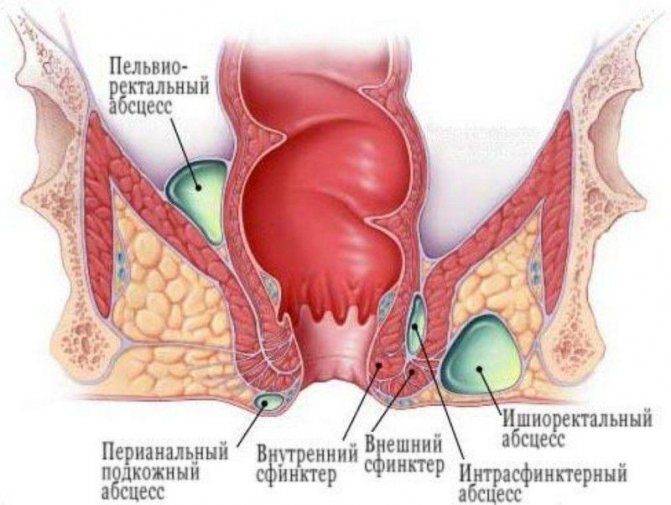 Чувство распирания в прямой кишке причины