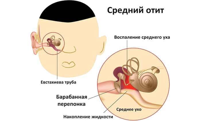 Препарат предназначен при отите (среднем)