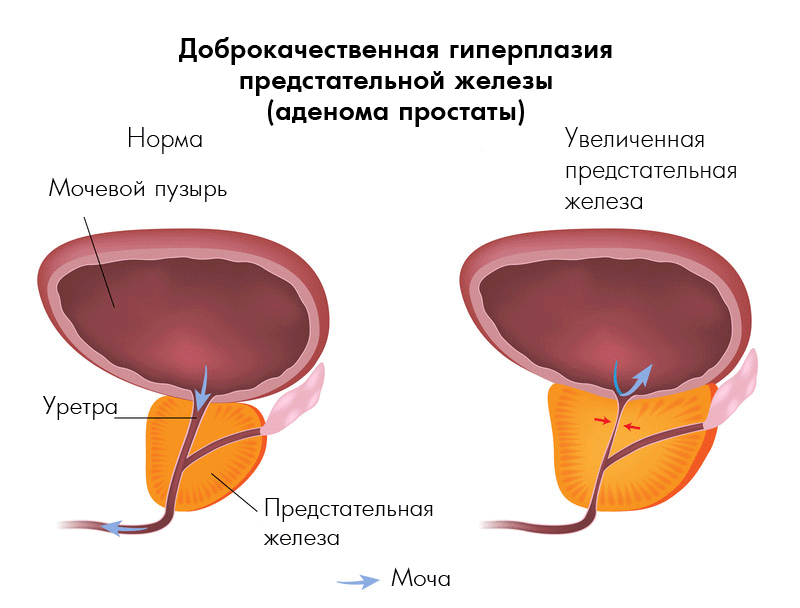 Аденома простаты