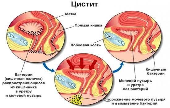 Передается ли цистит половым путем, от женщины к мужчине или от мужчины к женщине, а иначе говоря — заразен ли цистит?