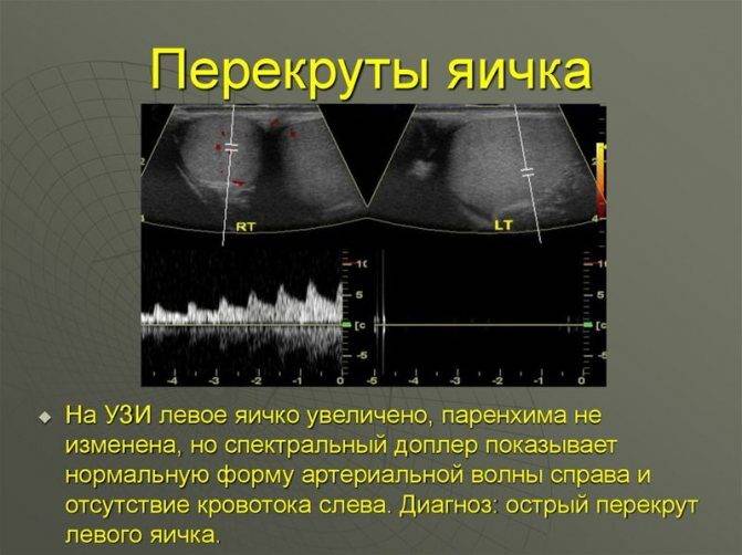 Перекрут семенного канатика яичка