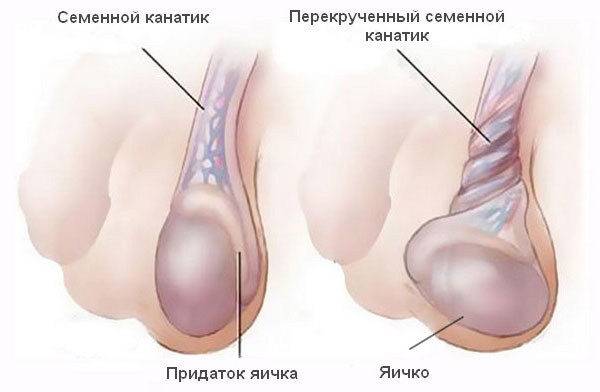 Перекрут семенного канатика яичка