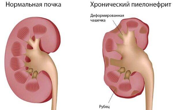 Пиелонефрит у ребенка. Симптомы, лечение. Антибиотики, народные средства