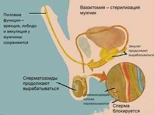 plyusy-i-minusy-sterilizatsii-1