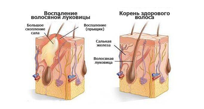 Большие прыщи на голове