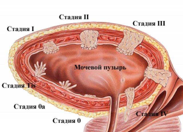 Стадии рака мочевого пузыря