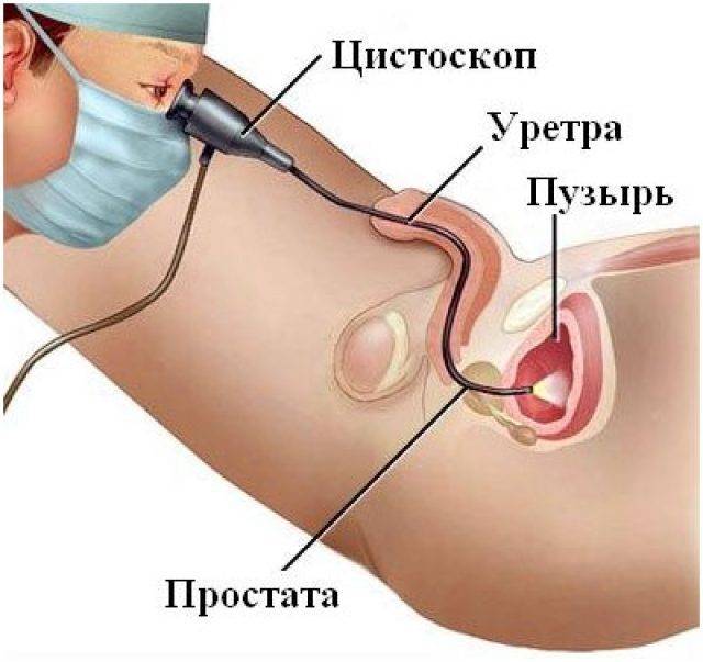 Проведение цистоскопии