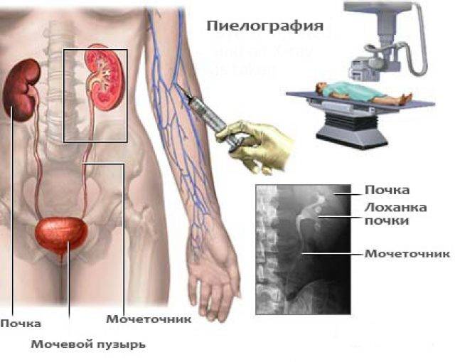 Внутривенная пиелография