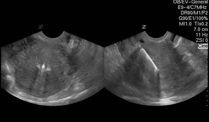 УЗИ полости матки с правильно установленной спиралью