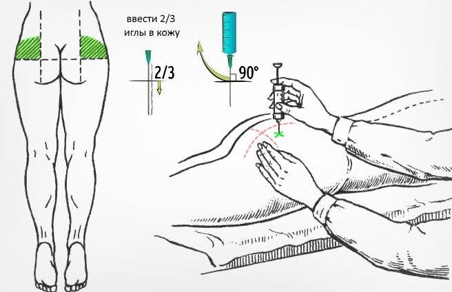 техника внутримышечной инъекции пациента