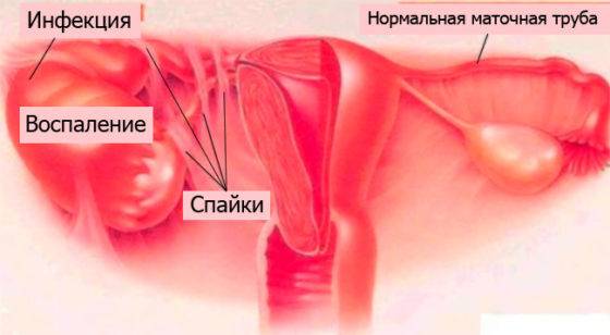 спайки