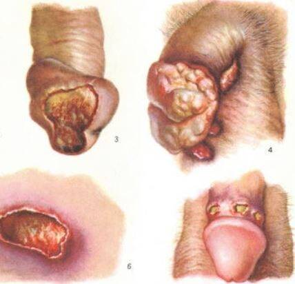 Первичный сифилис на члене