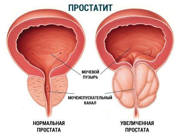 Хронический простатит прогноз лечения