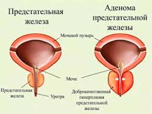 Аденома простаты