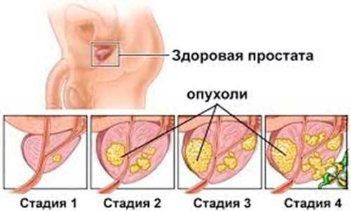 Опухоли простаты