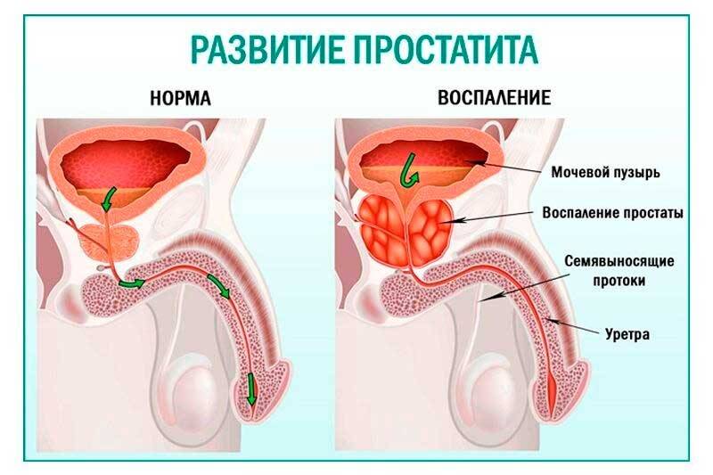 Развитие простатита