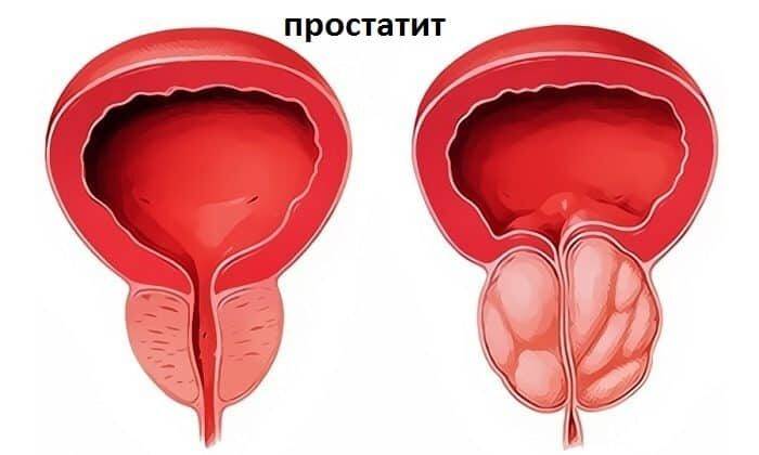 Также Флемоксин Солютаб может помочь в лечении простатита