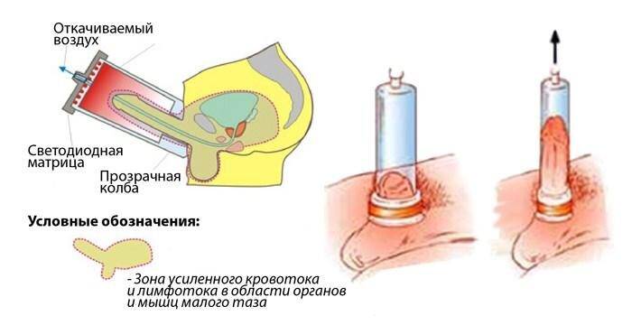 Лод терапия в урологии отзывы