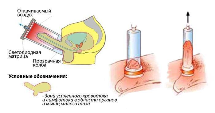 Лод терапия в урологии отзывы