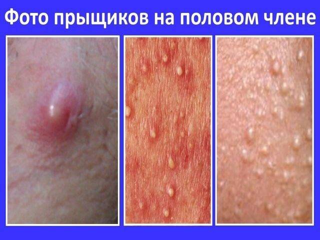 прыщики на крайней плоти