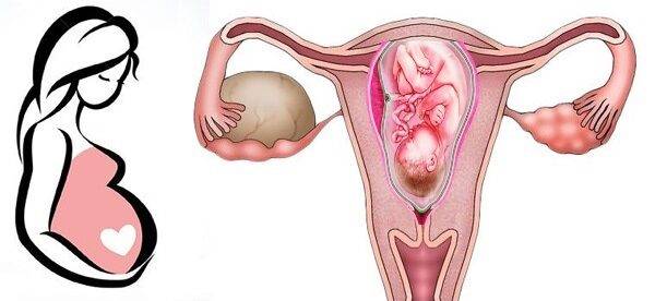 Влияние кисты на течение беременности
