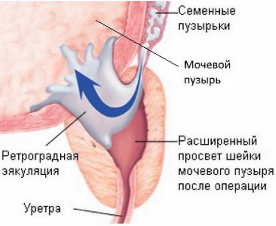 Редко ретроградная эякуляция