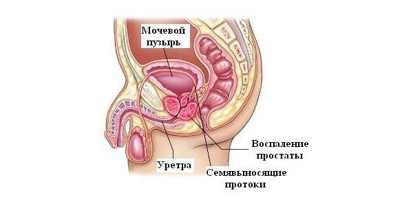 Простатит - частая причина желтой спермы