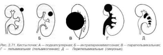 Синусовая киста правой почки