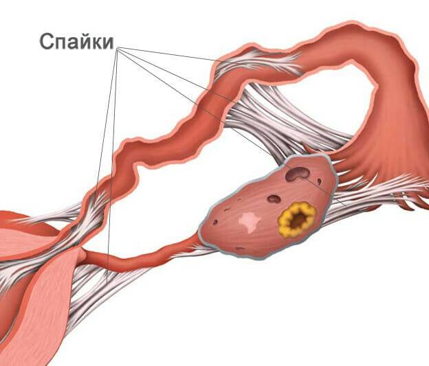 Спайки женских органов