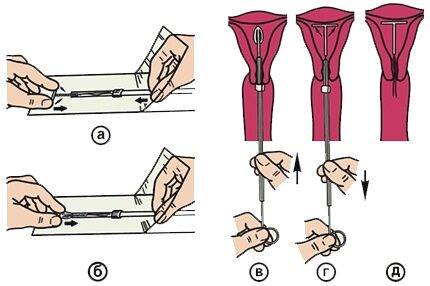 Спираль от беременности. Фото, виды, стоимость, как работает, как ставят