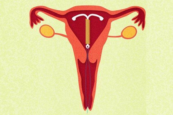 Внутриматочная спираль Мирена - побочные эффекты, отзывы врачей