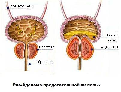 Степени аденомы простаты