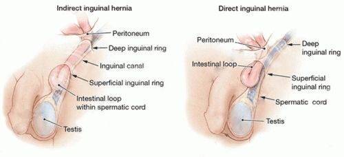 Типы паховой грыжи