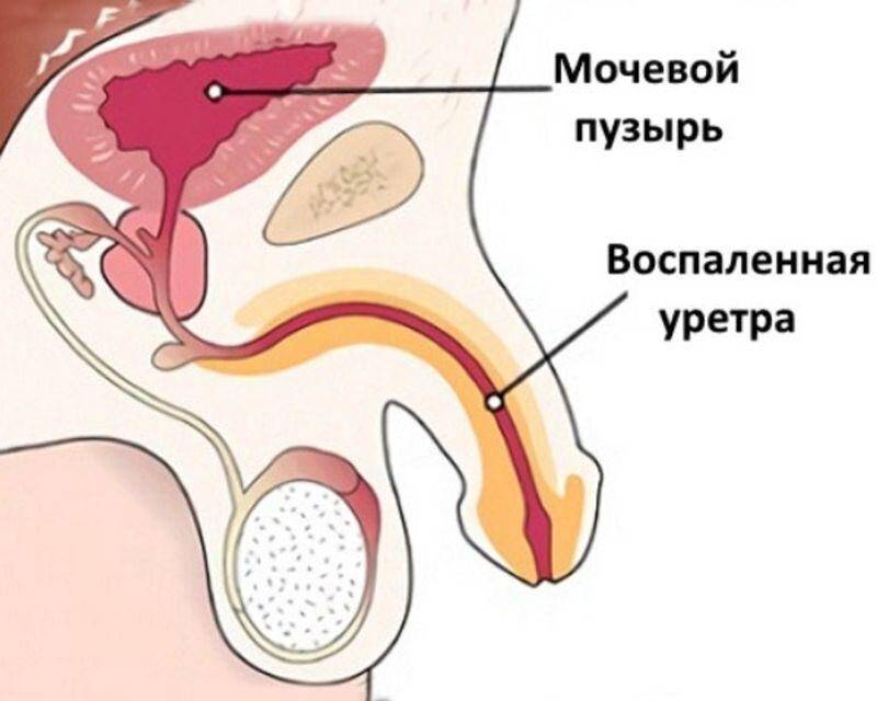 воспаленная уретра