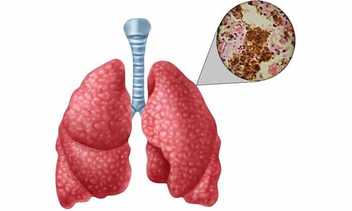 Препарат предназначен при легочном туберкулезе