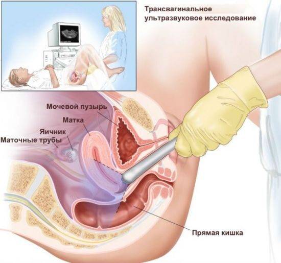 Трансвагинальное УЗИ