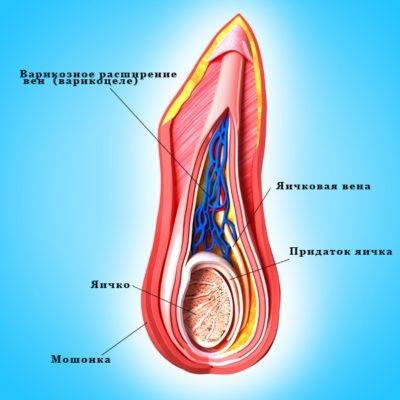 Температура при варикоцеле