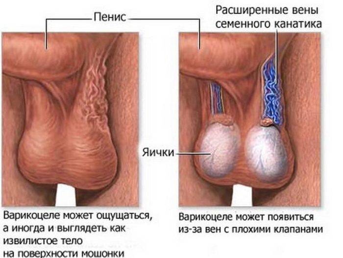 варикоцеле яичка