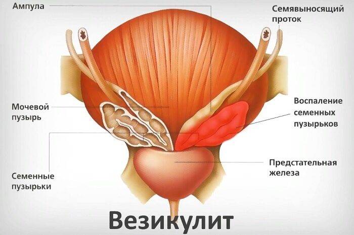 Везикулит на фото