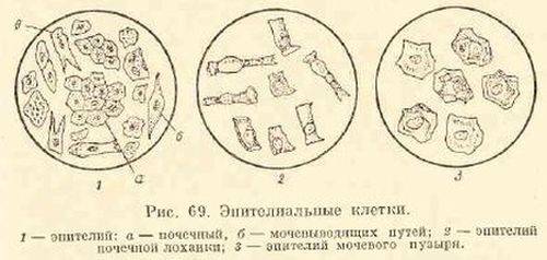 Слизь в моче - что это значит, как от нее избавиться?