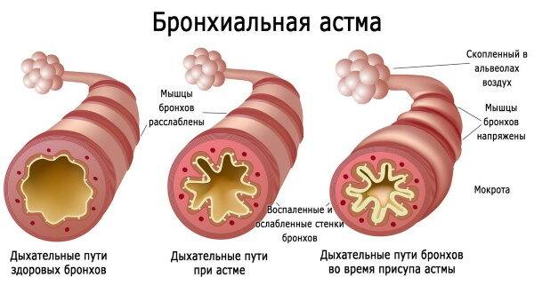 Мовалис (Movalis) уколы. Отзывы пациентов, инструкция, аналоги, цена