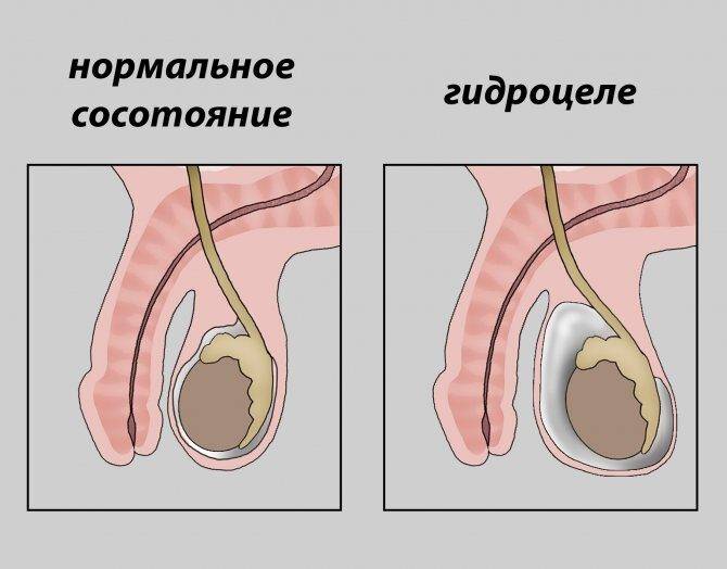 Причины водянки яичка у взрослого мужчины