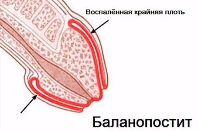 Воспаление головки и крайней плоти