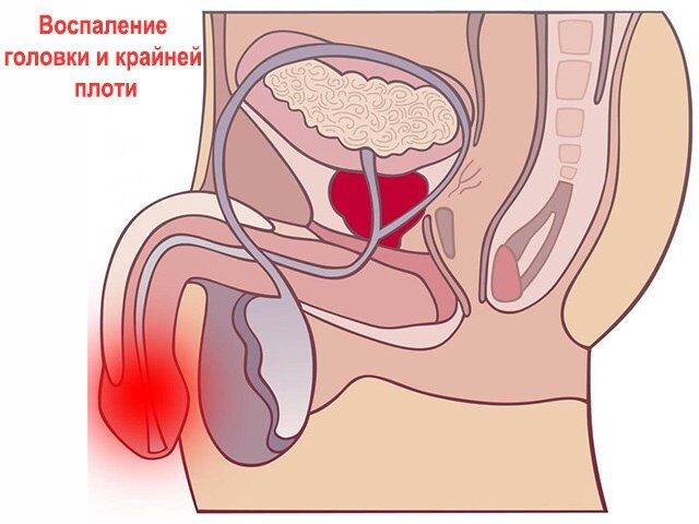 Лечение воспаления крайней плоти